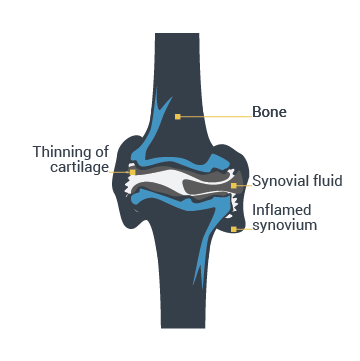 This is an image of an affected joint