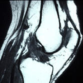 MRI of torn ACL