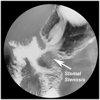 Stomal Stenosis Due To Post-surgical Scarring (biopsy Proven).