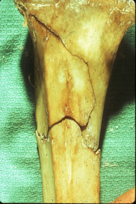 fractures posterior tibia