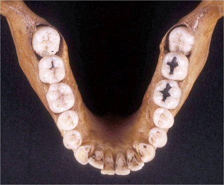 The Mandibular Teeth
