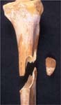 A Tibia with a Complete Fracture