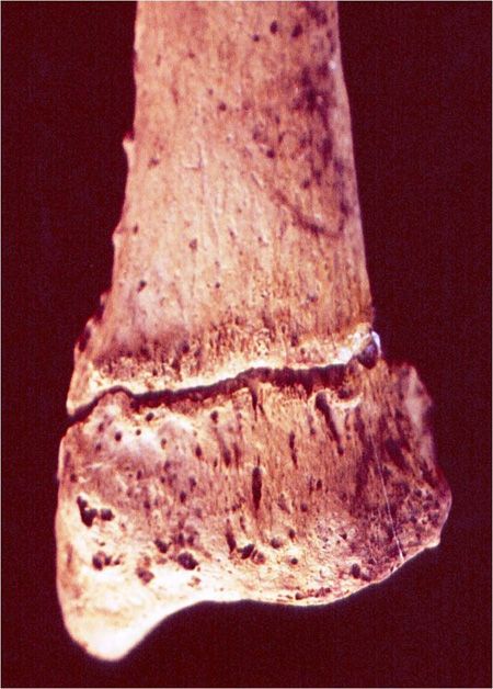 A Colle's Fracture