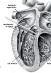 Ventricular Septal Defect composite