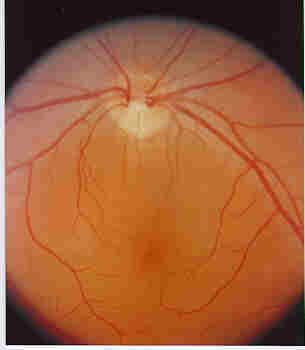 Fundus of a Normal Eye